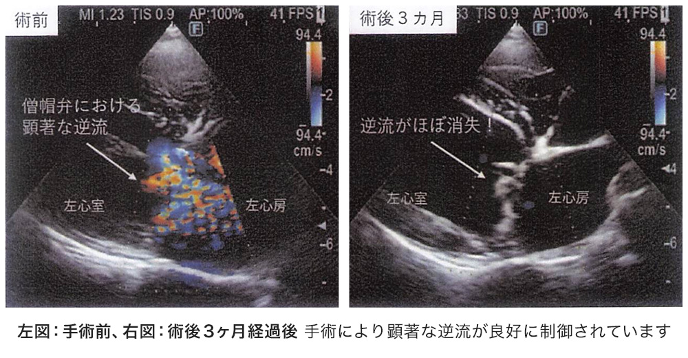 当院での僧帽弁形成術（MVP）実施後の経過エコー写真